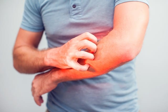 A model in a blue polo scratching a red, inflamed forearm