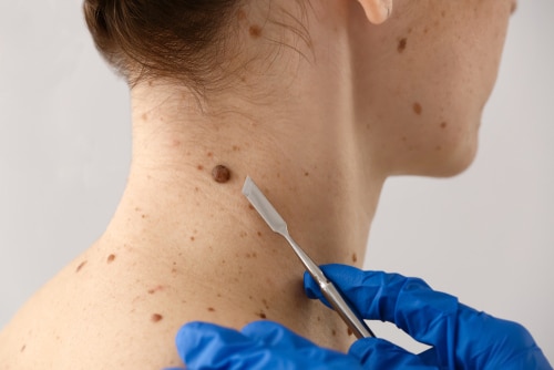 Doctor with lancet going to remove mole from patient's skin