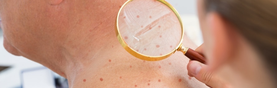 A magnifying glass held over a neck and shoulder with small red spots during a skin check