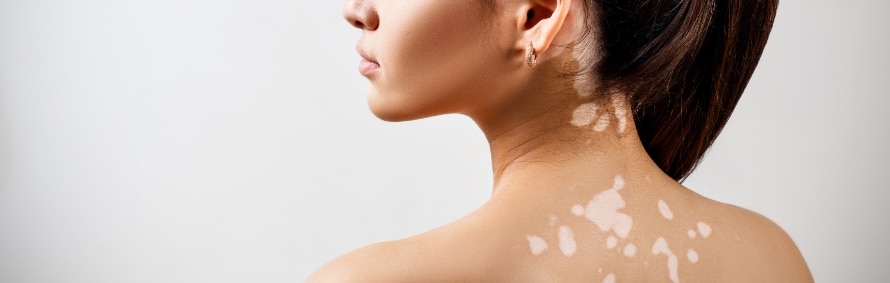 A woman seen from behind in profile with patches of lighter skin on her upper back and neck