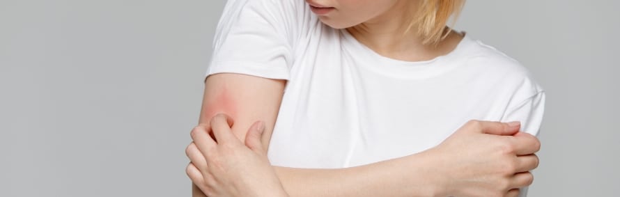 A model in a white t-shirt holding their arm with a patch of red, irritated skin