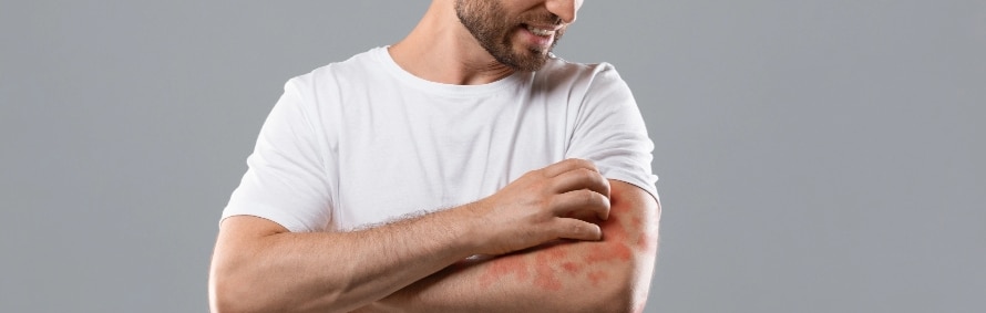 A model in a white t-shirt scratching a red patch on his forearm