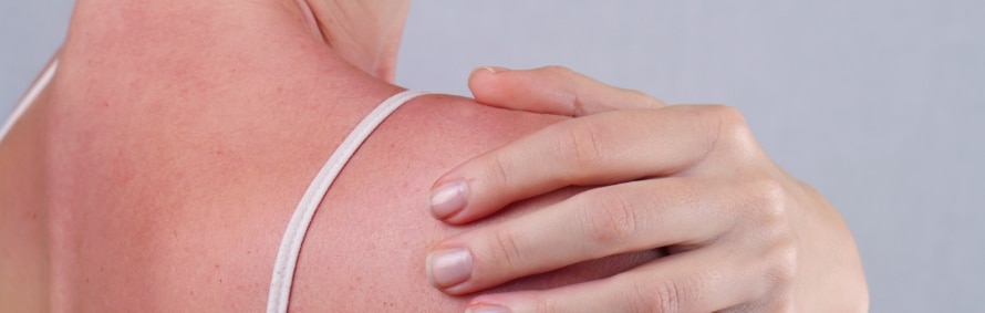 A sunburned shoulder with a hand resting on it