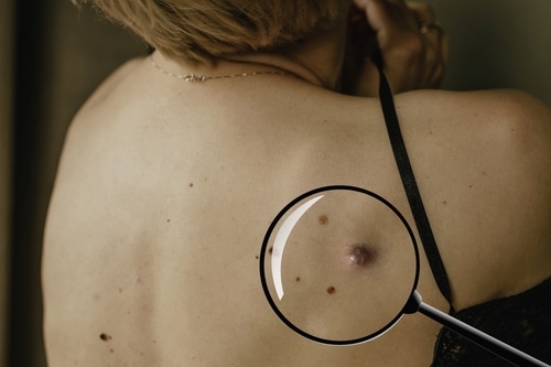 A woman's back with several moles, one seen through a magnifying glass