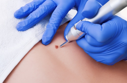 A blue-gloved hand using a small handheld device on a mole on a person's skin