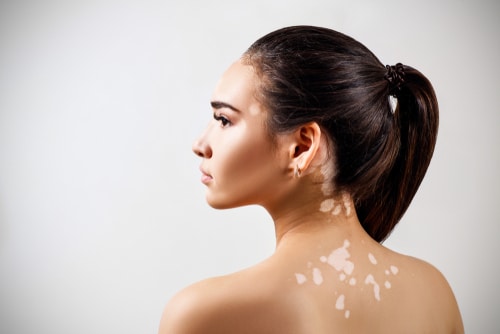 A model in profile seen from behind with lighter patches of skin on her neck and upper back