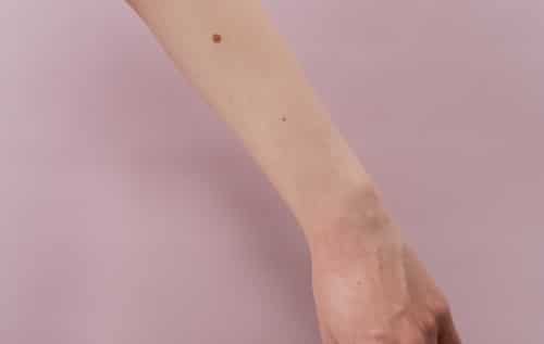 cosmetic mole removal