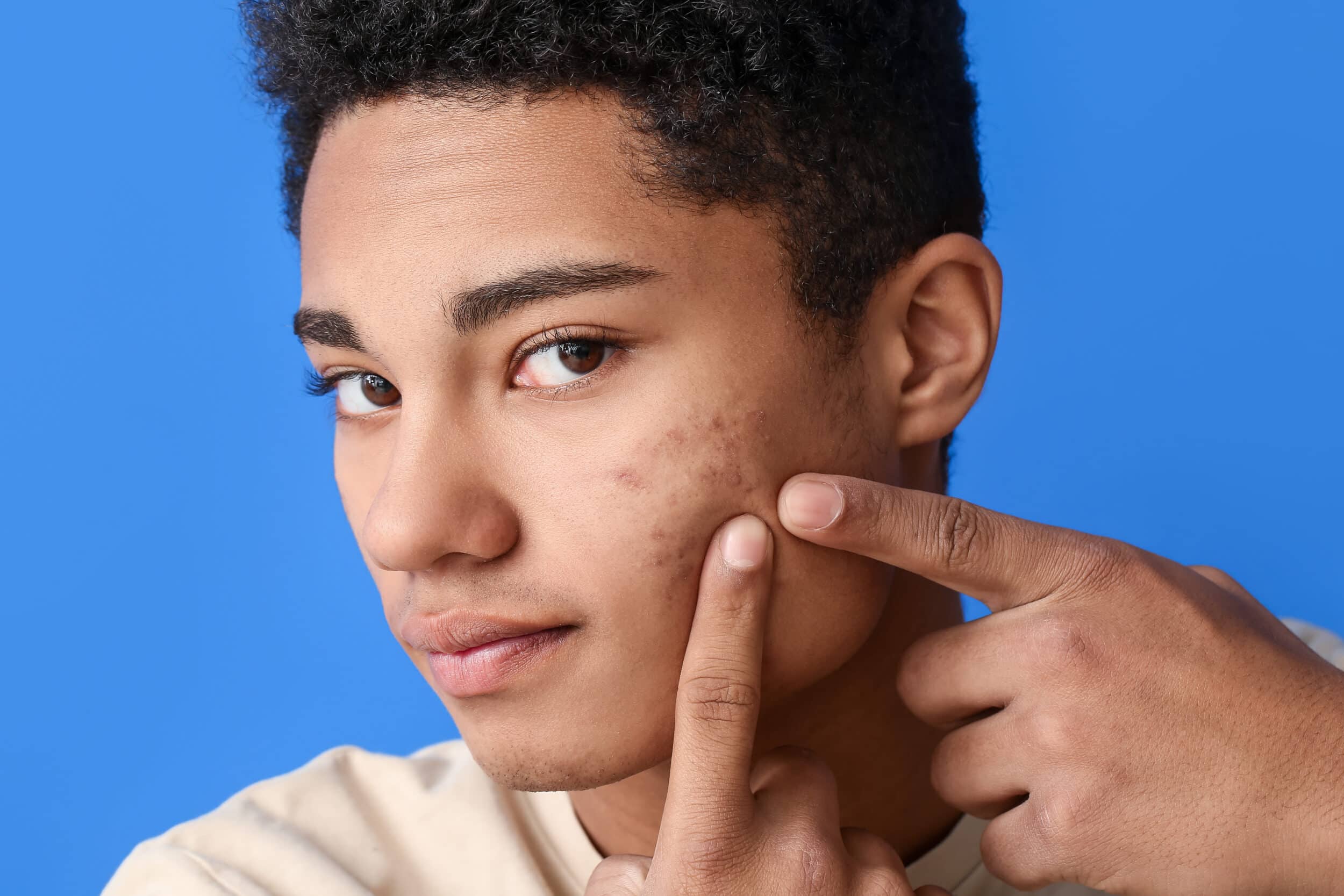 African-American teenage boy pointing to acne on his face in Miami.