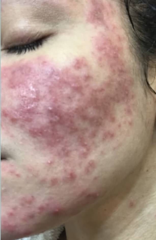 Before Image: Acne - left-side