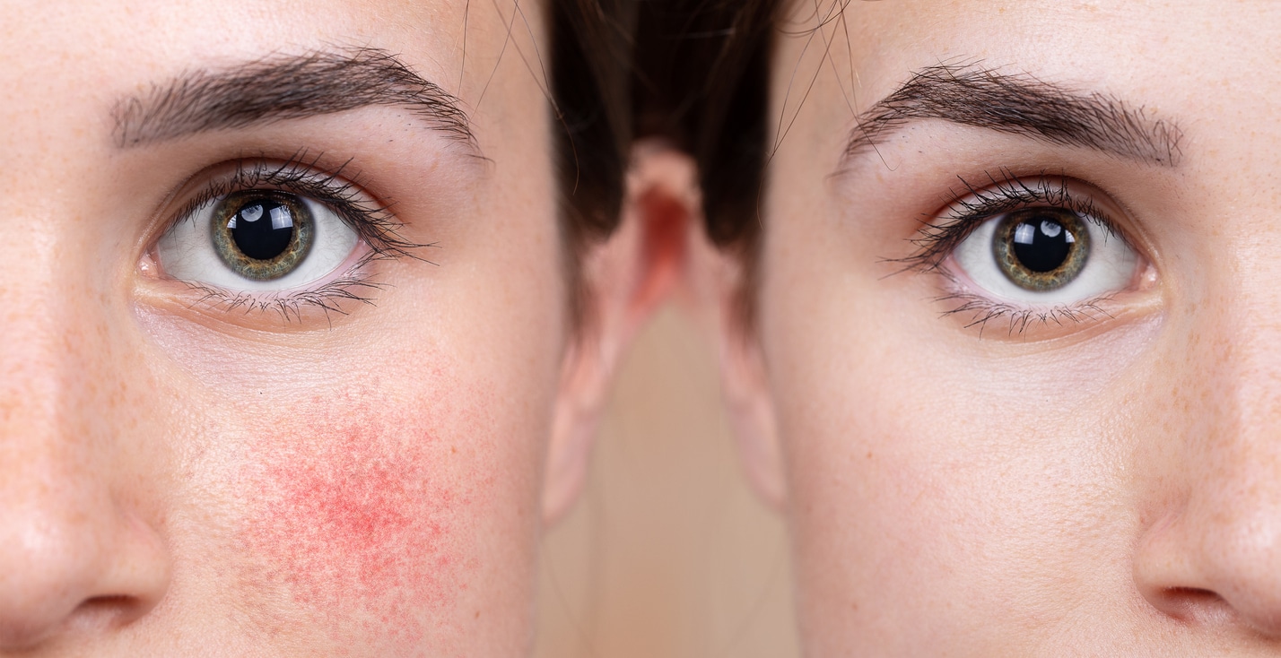 Before and after photos of a woman affected by rosacea.