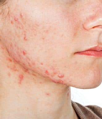 woman with hormonal acne 330x385 1