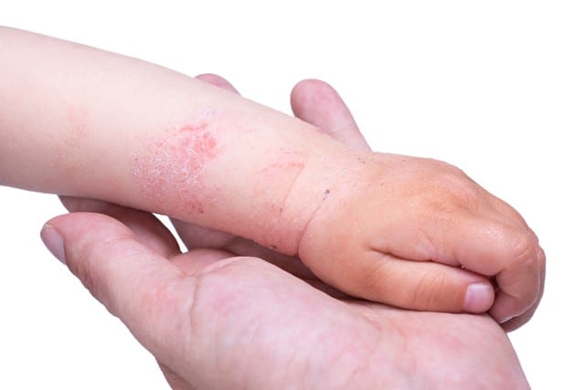 image of a baby's arm displaying eczema rash