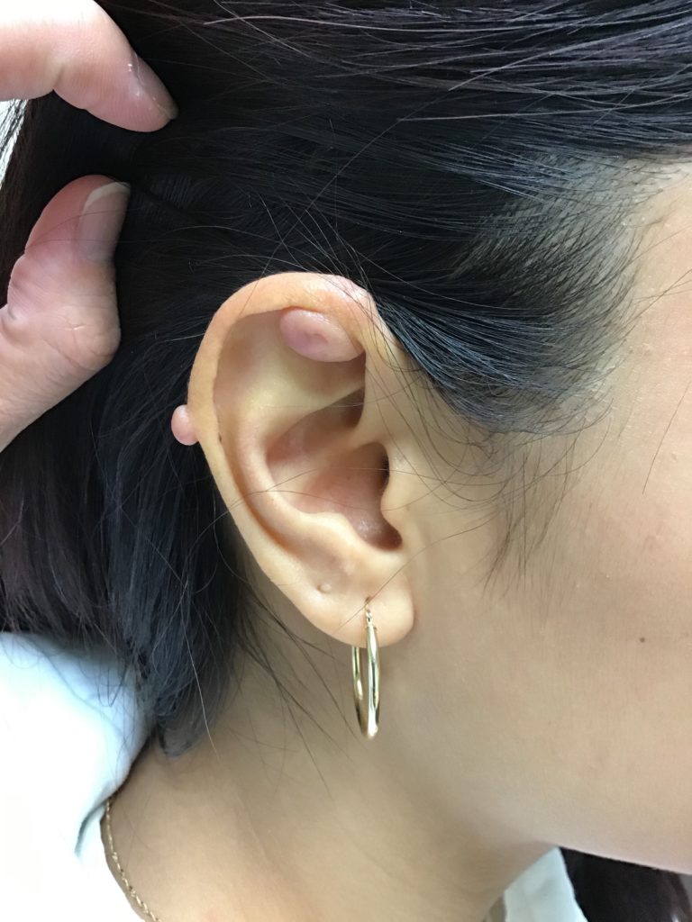 Ear Keloid Before Ear Keloid Before