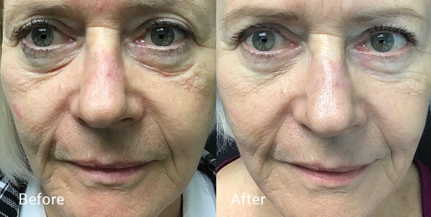 Before & after image of a woman's face showing improvements after laser skin treatments