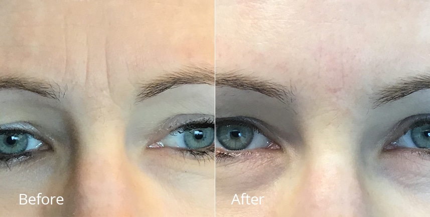 before & after image of botox treatment between the eyebrows to reduce frown lines