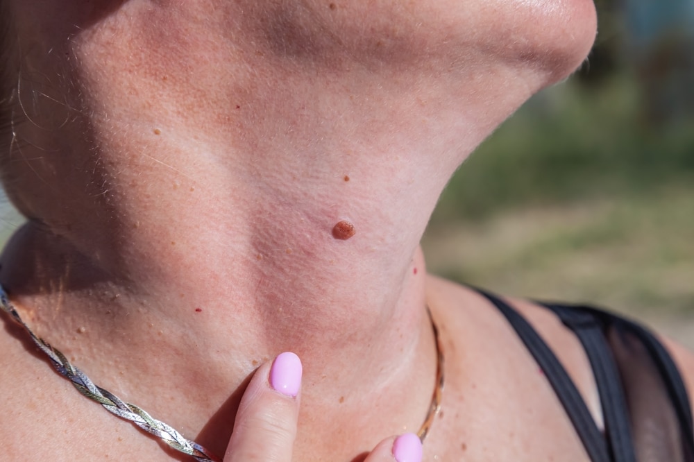 Melanoma treatment plan in Miami, FL