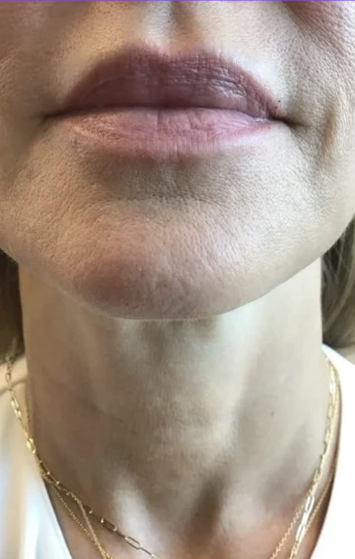 After Image: Botox Cosmetics for Necklines - front