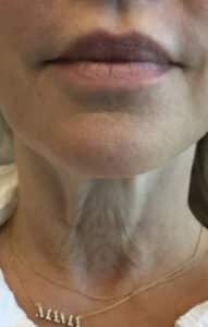 Before Image: Botox Cosmetics for Necklines