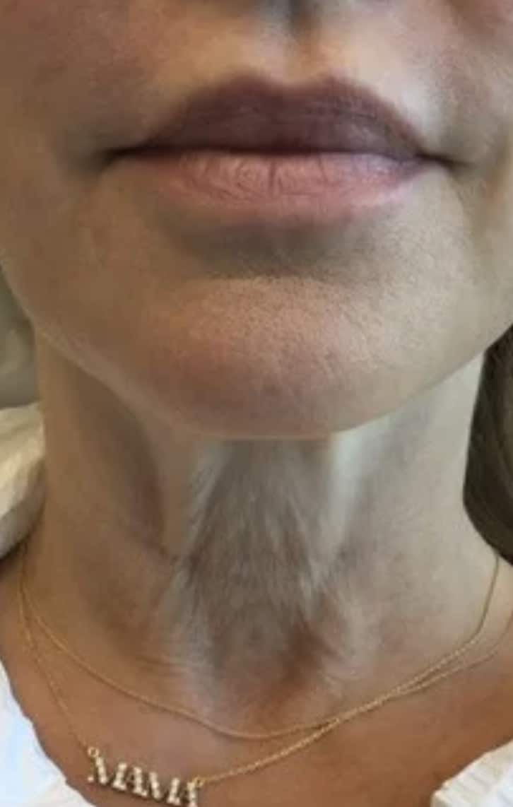 Before Image: Botox Cosmetics for Necklines - front