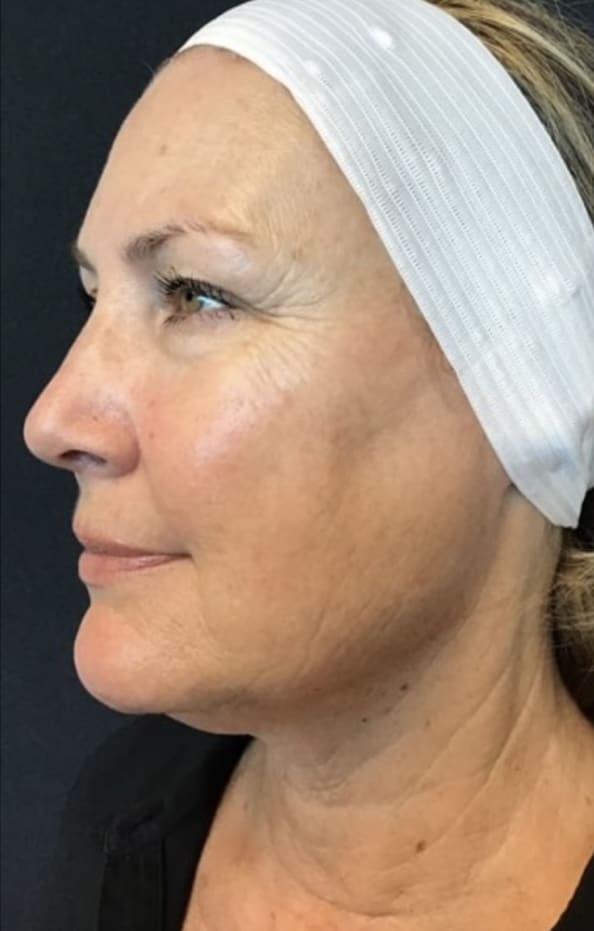 After Image: Halo Laser for Sun Spots - left-side