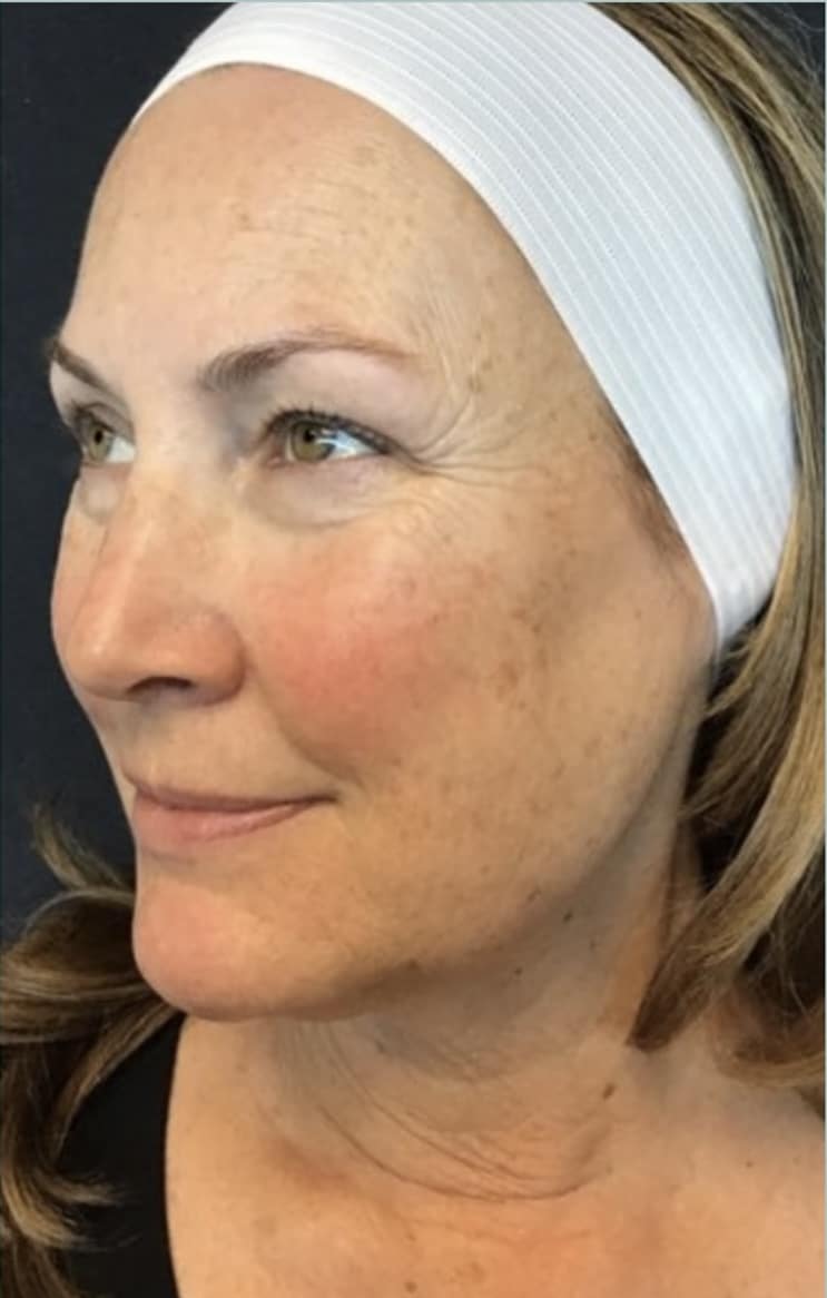 Before Image: Halo Laser for Sun Spots - left-side