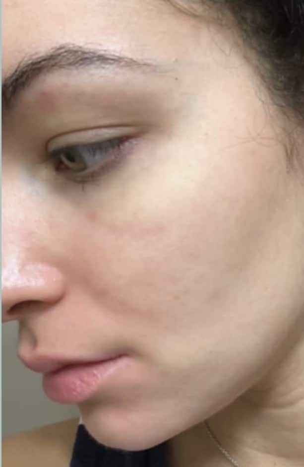 After Image: Acne - left-side