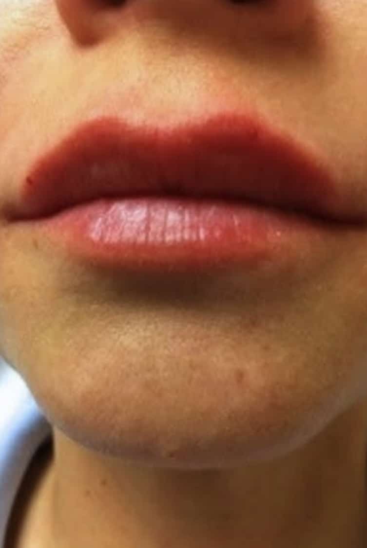After Image: Fillers - front
