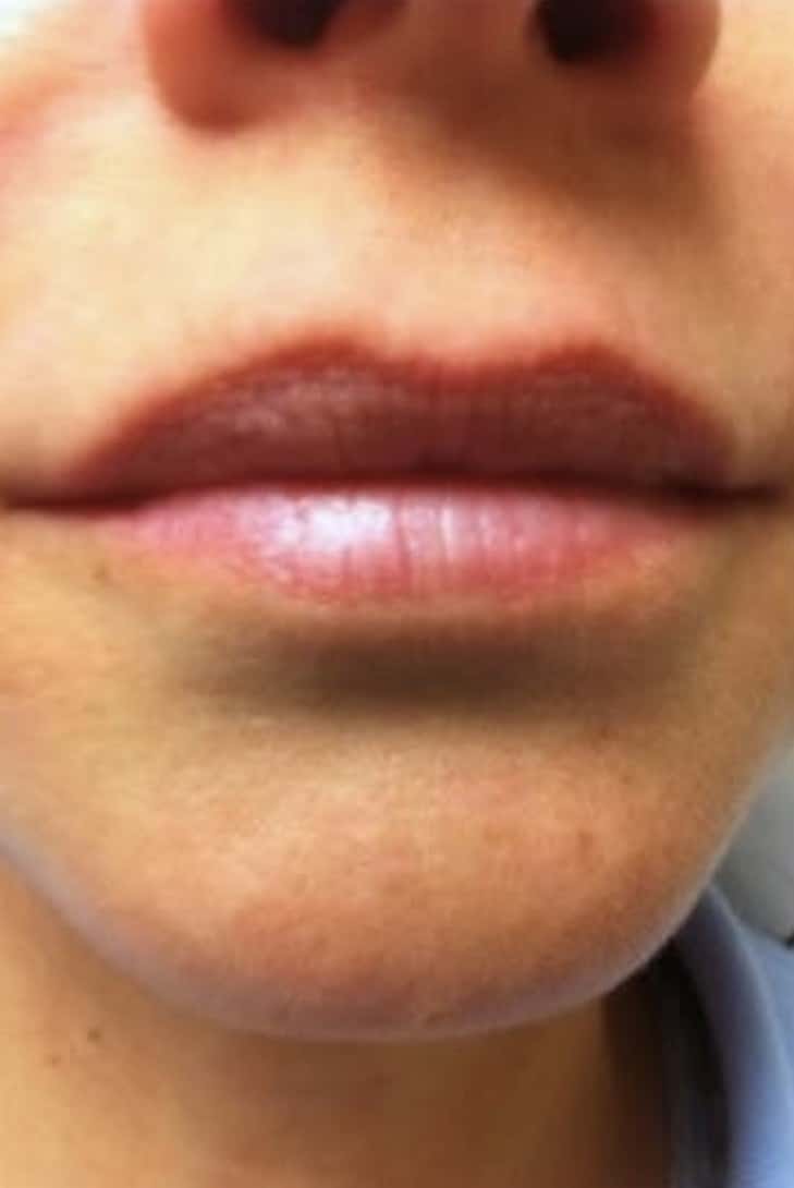 Before Image: Fillers - front