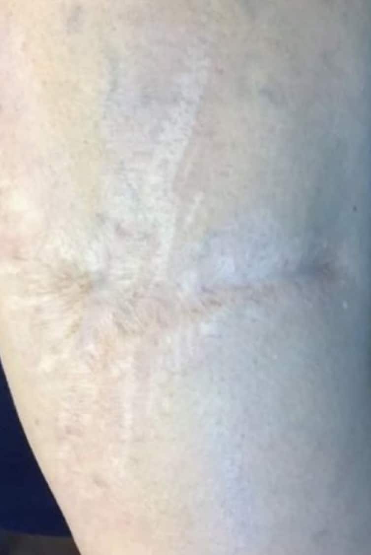 After Image: Sciton - front