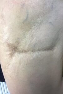 Before Image: Sciton