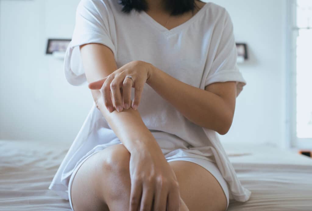 Woman experiencing psoriasis flare up in Miami, FL
