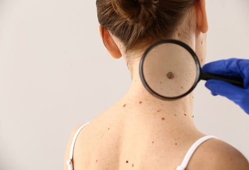 Patient holds magnifying glass to her neck to examine a mole that has changed.