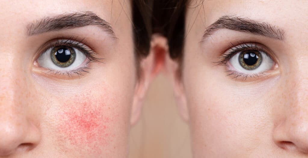 Before and after photos of a woman affected by rosacea.